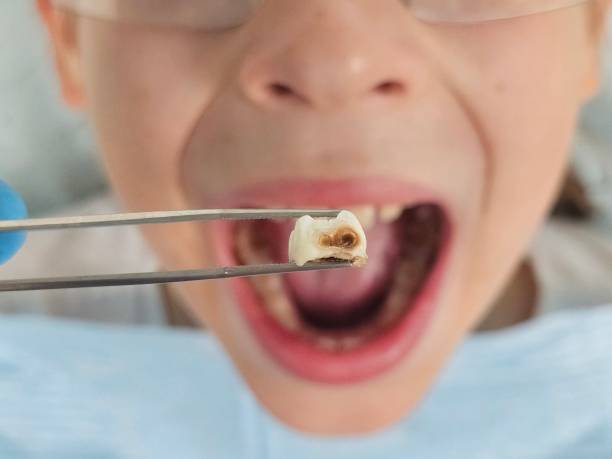 Best Emergency Dentist for Knocked-Out Tooth in Madison, AL